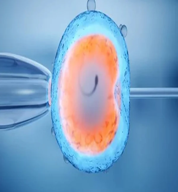 Intracytoplasmic Sperm Injection (ICSI) Fertility Treatment